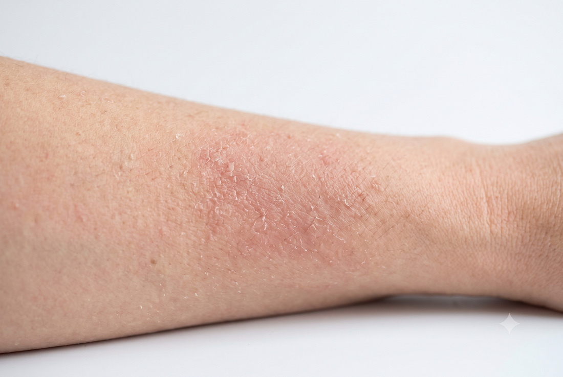 Hard Water, Chlorine and Eczema: What the Research Actually Shows