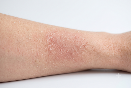 Hard Water, Chlorine and Eczema: What the Research Actually Shows